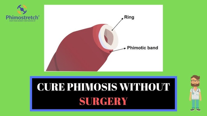 Phimosis Stretching Rings Kit for tight foreskin treatment