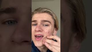 How to cover your acne as a guy screenshot 2