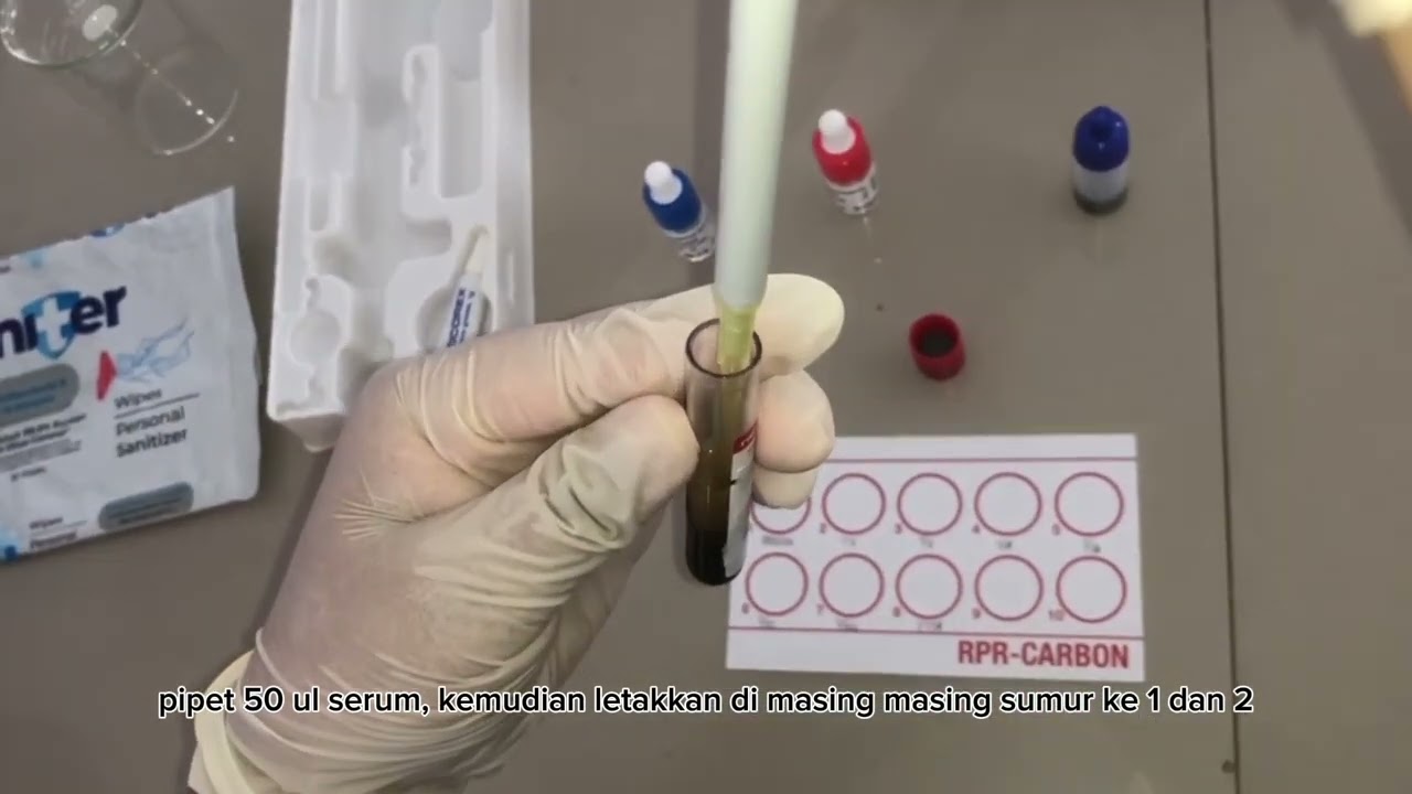 Pemeriksaan RPR Sifilis Metoda TPHA (Hemaglutinasi) - Tugas Akhir Kelompok 8 Kelas D3 A Tingkat 1