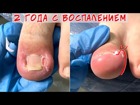 Вросший ноготь - 2 года с воспалением😨