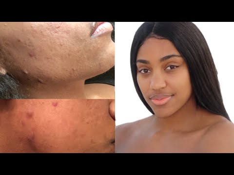 HOW TO GET RID OF CYSTIC ACNE, FADE DARK SPOTS & SCARS| SKIN CARE ROUTINE