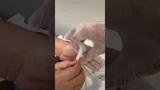 Paraffin wax for hand stiffness علاج التصلب اليد بالشمع البيرافين @FahdAlhasan