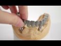 K Dental Lab-Implant-1.mov