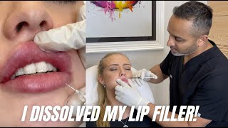 Getting my migrated lip filler dissolved!