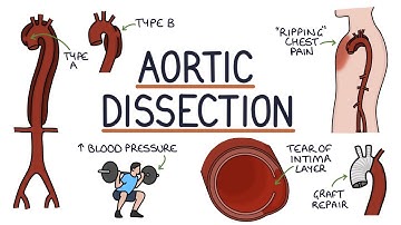 Understanding Aortic Dissection