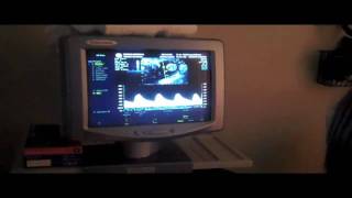 Ultrasound Growth Scan- 29 Weeks