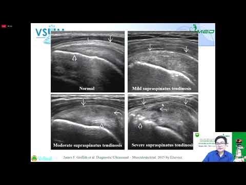 Video Siêu âm cơ xương khớp: phần 8 - Viêm gân cơ trên gai -... - youtube