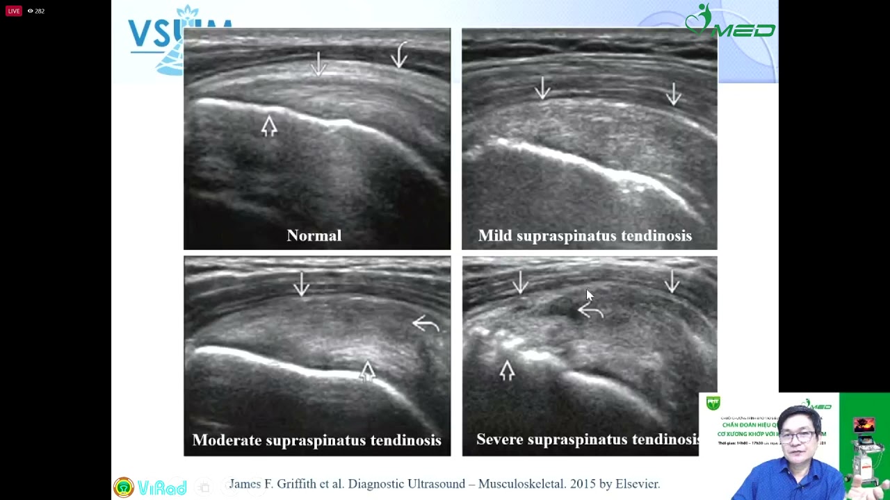 Siêu âm cơ xương khớp: phần 8 - Viêm gân cơ trên gai - BS. Nguyễn Quang Trọng