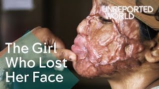 Bangladesh acid attack survivors helping each other heal | Unreported World