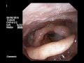 Cancer of the hypopharynx  wwwdrjeevecom