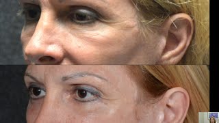Beverly Hills Eyelid Surgery Eye Lift - Eyelid Tightening With Fat Transposition To Fill Hollows