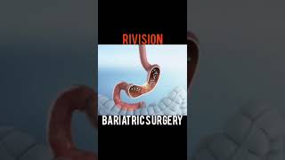 Revision Bariatric Surgery For Weight Loss