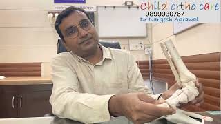 Metatarsal Adductus can be corrected @childorthocare #clubfoot #ctev #clubfeet #tecemedepa