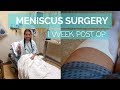 Meniscus Surgery Recovery Vlog: Week 1 Post Op