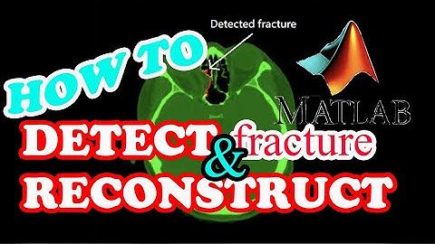 【MATLAB - Detect & Reconstruct】How to detect orbital fracture and reconstruct a 3D model?