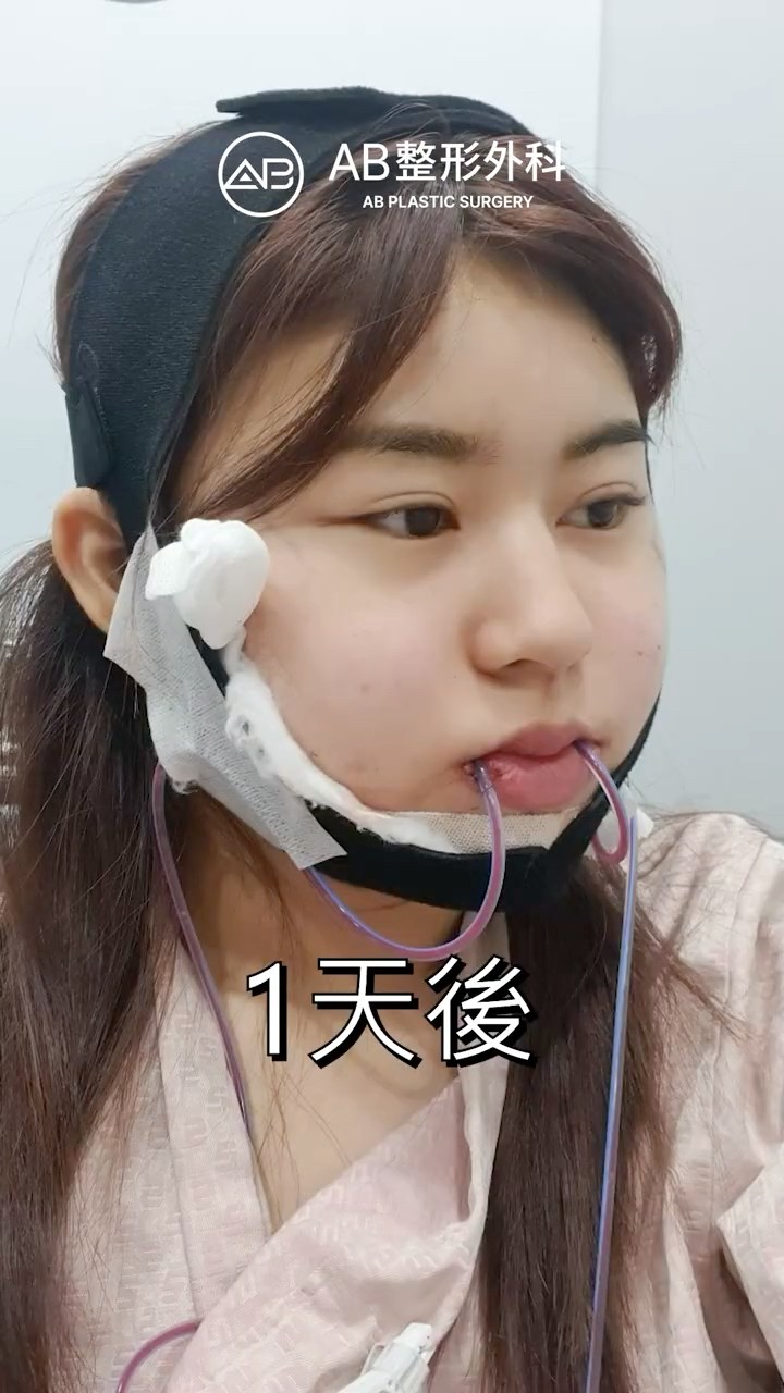 在韓國做小臉手術 #shorts