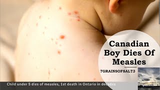 Canadian Boy Dies Of Measles by 7grainsofsalt 3 1,372 views 7 days ago 3 minutes, 45 seconds