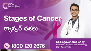 Play video: Stages of cancer explaining by Dr. Ragavendra Reddy