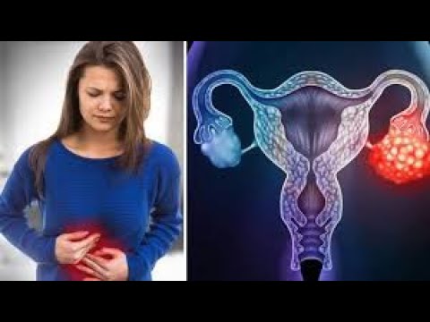 Βίντεο: Συμπτώματα και θεραπεία φλεγμονής των ωοθηκών στις γυναίκες