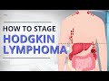 Hodgkin Lymphoma Staging: From Diagnosis to Prognosis | The Patient Story