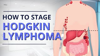 Hodgkin Lymphoma Staging: From Diagnosis to Prognosis | The Patient Story