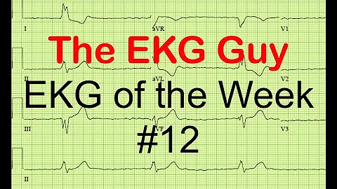 EKG/ECG of the Week #12 | The EKG Guy - www.ekg.md