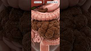 How Stool Gets Stuck | Constipation Process in the Large Intestine Animation || Anatomy