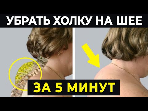 Как убрать холку на шее за 5 минут? | ВДОВИЙ ГОРБИК исчезнет навсегда!