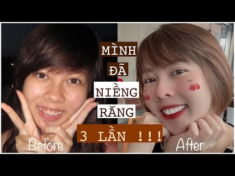 Video MÌNH HỐI HẬN VÌ ĐÃ NIỀNG RĂNG!? VÌ SAO MÌNH PHẪU THUẬT... - youtube
