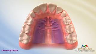 Orthodontic Expander or Spacer - Dynaflex Appliance