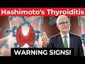 Do Not Ignore These Hashimoto's Thyroiditis Symptoms