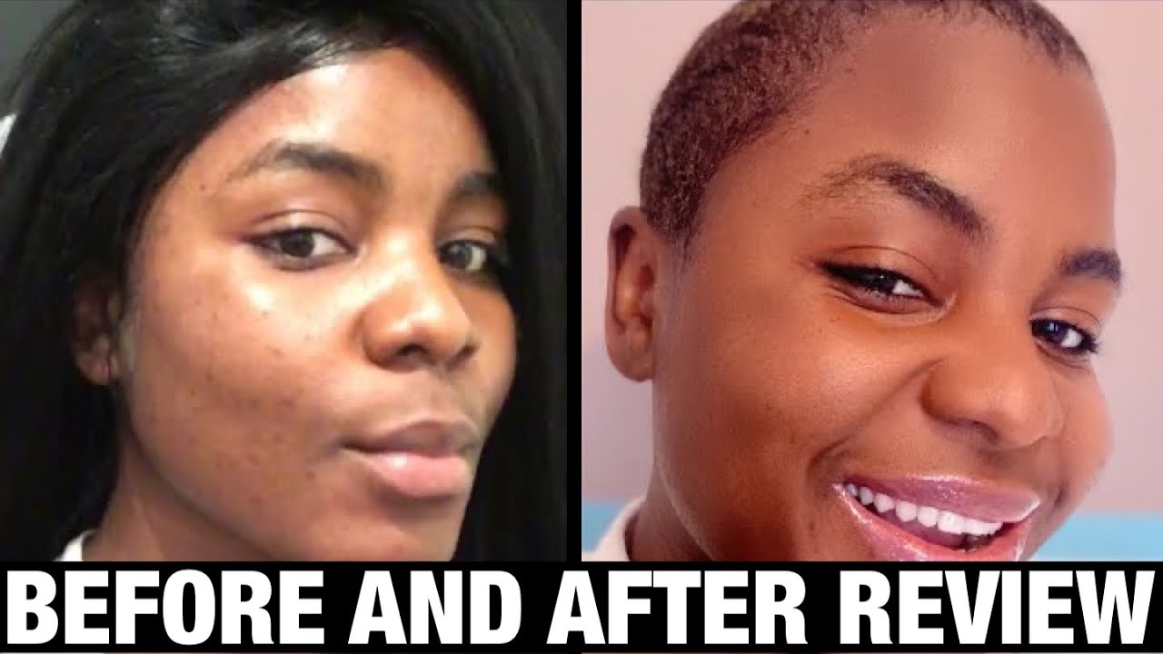 How to get a clear skin with kojic acid soap * honest review * YouTube