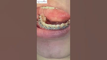 Niềng Răng Với Thun Chuỗi – Nhỏ Mà Có Võ! | Nha Khoa MARINA #nhakhoamarina #dentalclinic #dentist