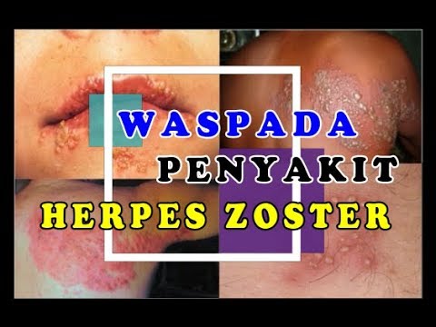 video editing software free Obat Herpes Zoster - Cara Mengobati Herpes Sampai Tuntas
