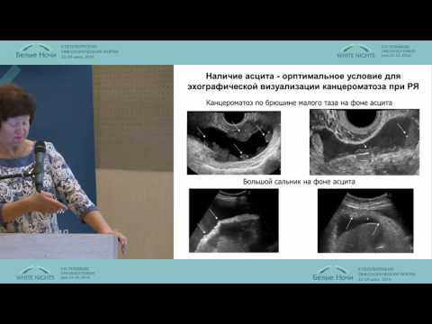 Видео: Несбалансированная сегрегация отцовского T (9; 11) (p24.3; P15.4) транслокации, вызывающая семейный синдром Беквита-Видемана: пример случая