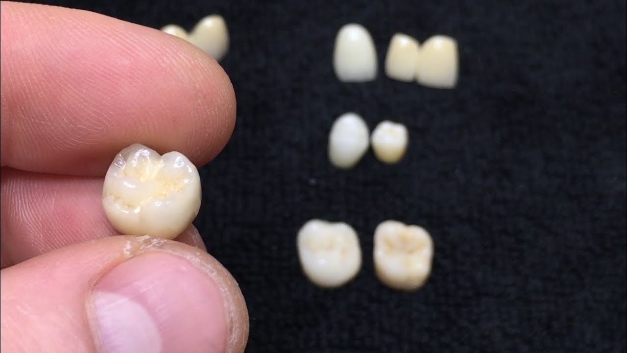 Какие зубные коронки лучше?Преимущество безметалловой керамики перед ...