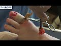 FUNGAL TOENAIL REMOVAL