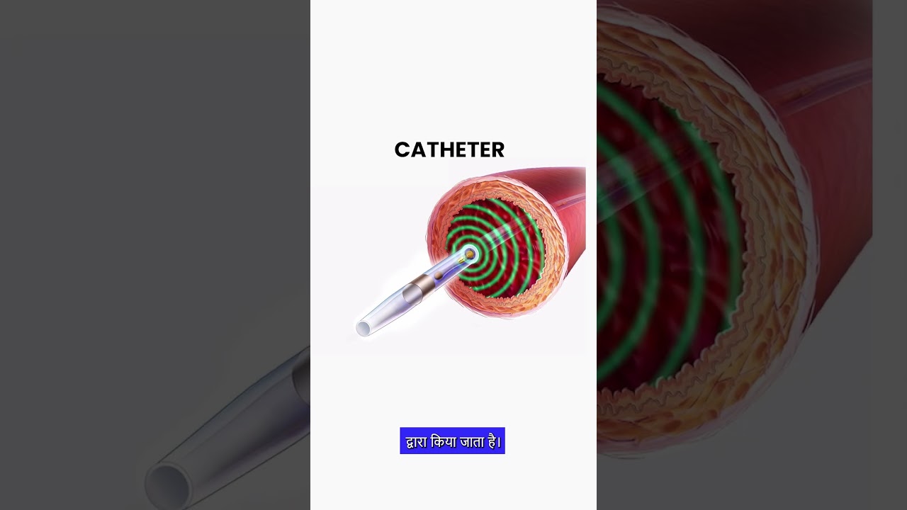 What Is Deep Vein Thrombosis (DVT)? By Dr. Prashant Pote