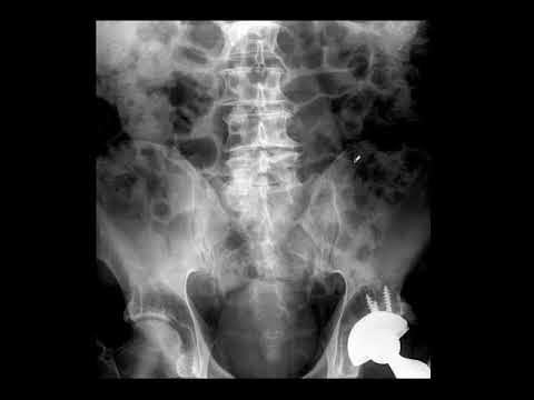 Bone Scintigraphy I : Basics