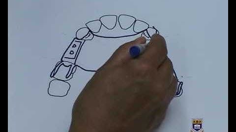 Designing an Upper Metal Partial Denture Kennedy Class III