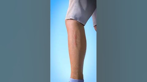 How Stitches Work 😯