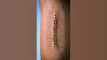 How Stitches Work 😯