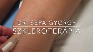 Szkleroterápia (sclerotherapia) - Dr. Sepa György érsebész