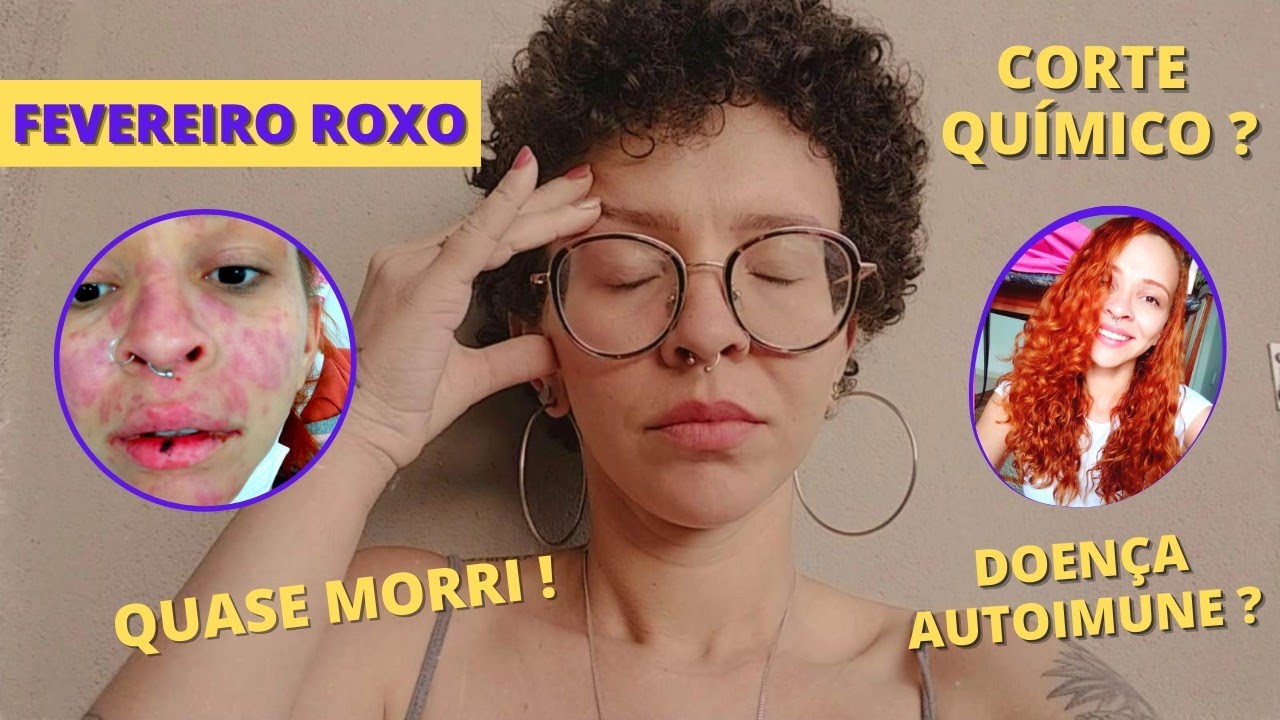 QUASE MORRI! Minha experiência com o Lúpus