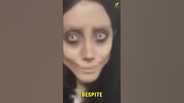 Plastic Surgery Disaster #plasticsurgery #gonewrong  #botched