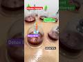 Hijama Cupping therapy at clinic #hijamacupping  #backpainexercises  #hijamabenefits #hijama