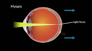 Myopia and Eye Development