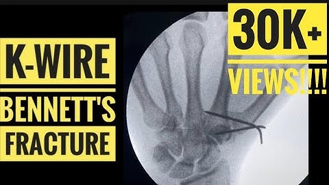 K-Wire Fixation of Bennett