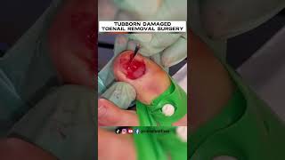 STUBBORN DAMAGED TOENAIL REMOVAL SURGERY 2023 BY FAMOUS PODIATRIST MISS FOOT FIXER