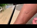 Skin peeling manual. 人工脫皮、曬傷剝皮